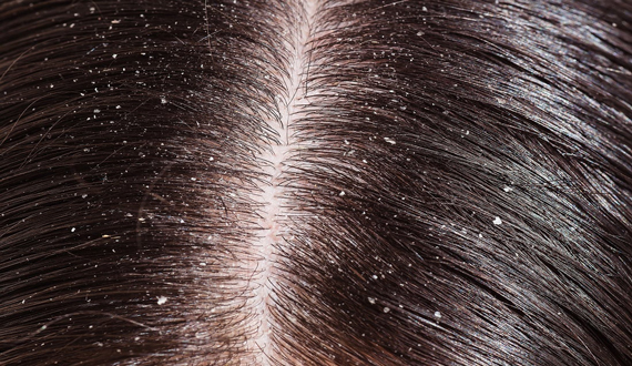 Best Home Remedies To Clear, Reduce Dandruff Naturally